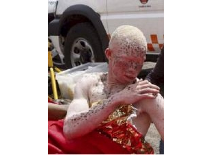 Un albino africano